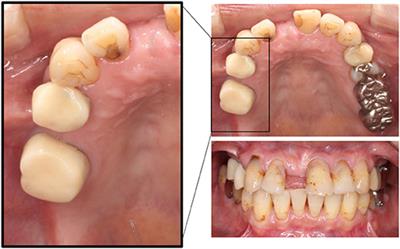 Case Report: Iatrogenic Dental Progress of Phantom Bite Syndrome: Rare Cases With the Comorbidity of Psychosis